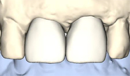 VAD上で最終歯牙形態を再現