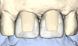 確定した歯牙形態からアバットメントをデザイン