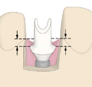 歯肉縁下深さで設定